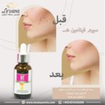 سيروم فيتامين هـ من ليفانا لعلاج آثار حب الشباب وتوحيد لون البشرة – نتائج واضحة قبل وبعد الاستخدام